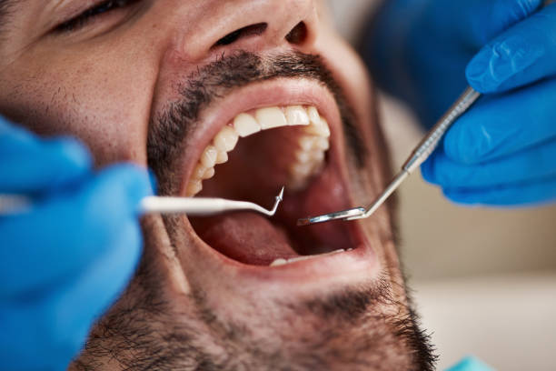 Best Emergency Tooth Extraction in Fort Ashby, WV